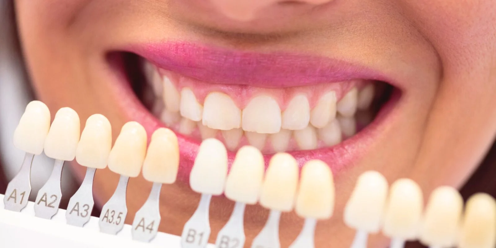 Clareamento Combinado