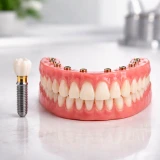 Implantes Dentários